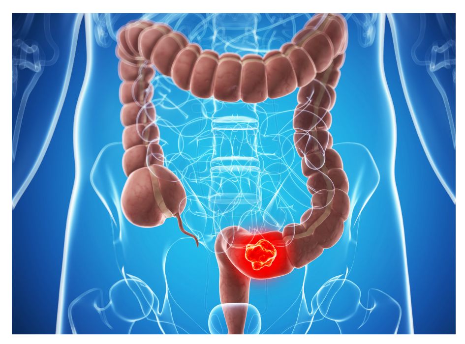 cirugia Cáncer Colorrectal