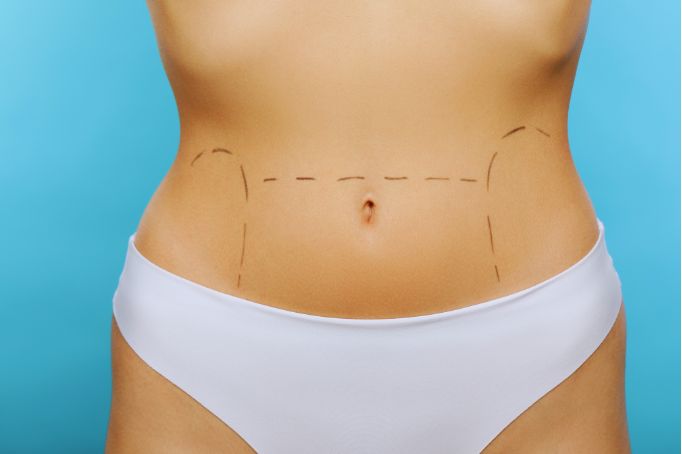 mini abdominoplastia marbella y malaga