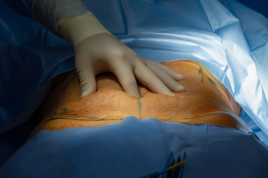 operación abdominoplastia en Málaga