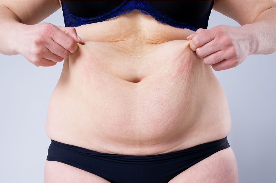mujer antes abdominoplastia en Málaga