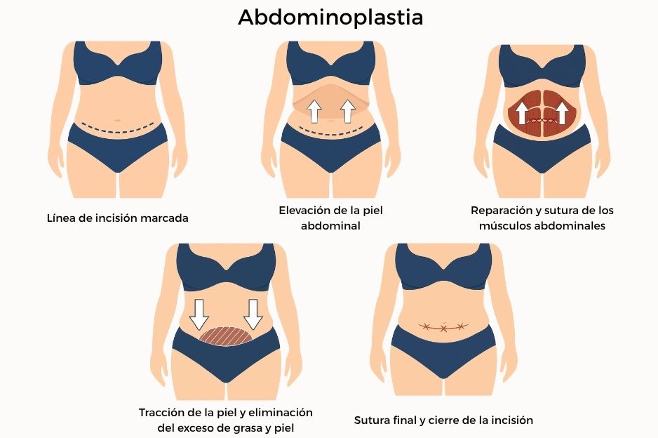 tratamiento abdominoplastia en Málaga