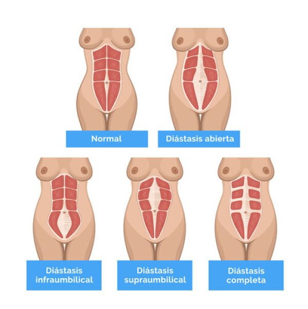información sobre Diástasis abdominal